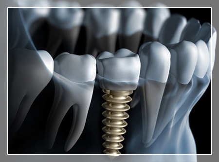 İmplant operasyonu ağrılı bir işlem midir?