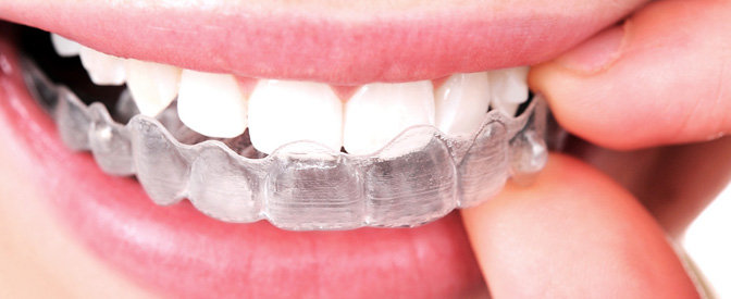 Şeffaf Plaklar (Telsiz) İle Ortodontik Tedavi