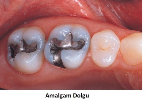 Amalgam Dolgu